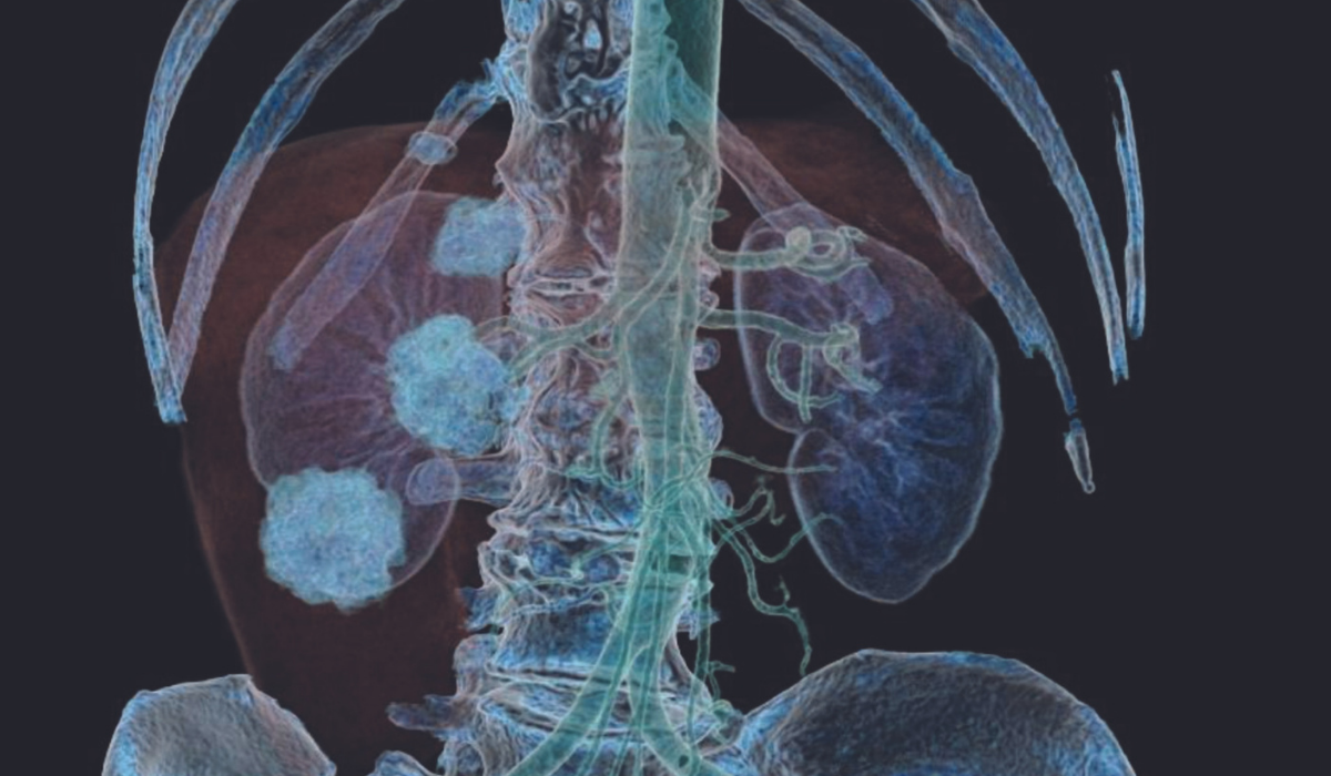 Interventional Radiology Package TeraRecon